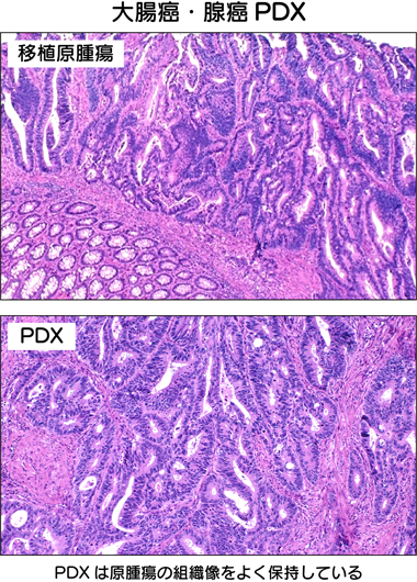 大腸癌・腺癌PDX